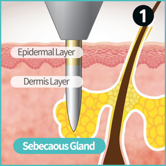 Epidermal Layer, Dermis Layer, Sebecaous Gland