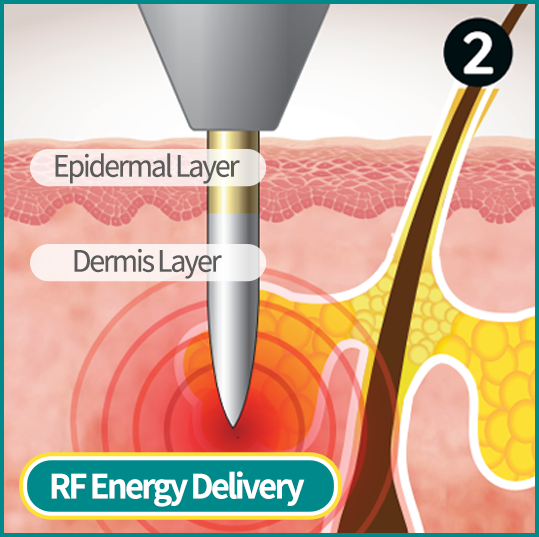 Epidermal Layer, Dermis Layer, Sebecaous Gland
