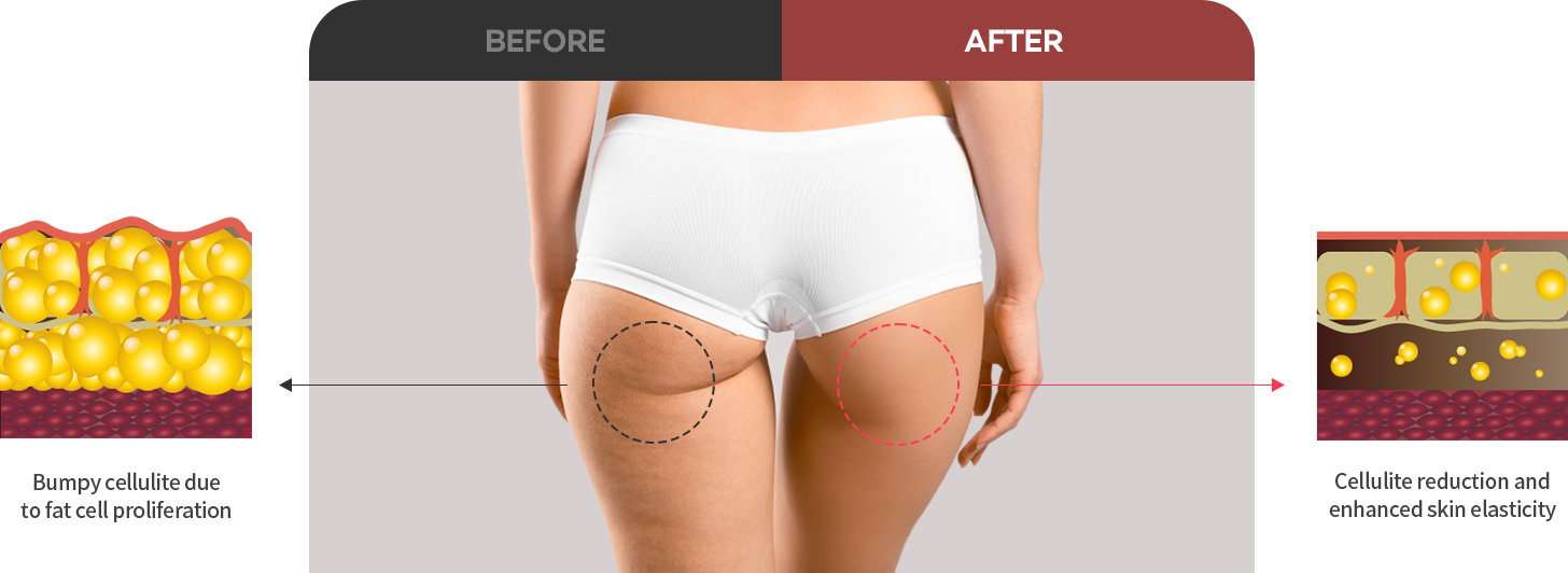 Slim Down Specific Areas Quickly and Easily Cellulite fat cells are<br> <span>large, stable and do not break down easily
